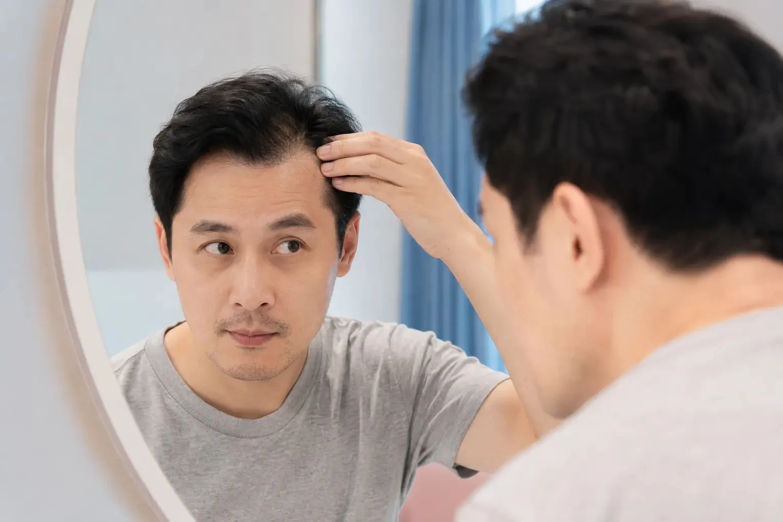 男性髮際線與頭頂稀疏困擾